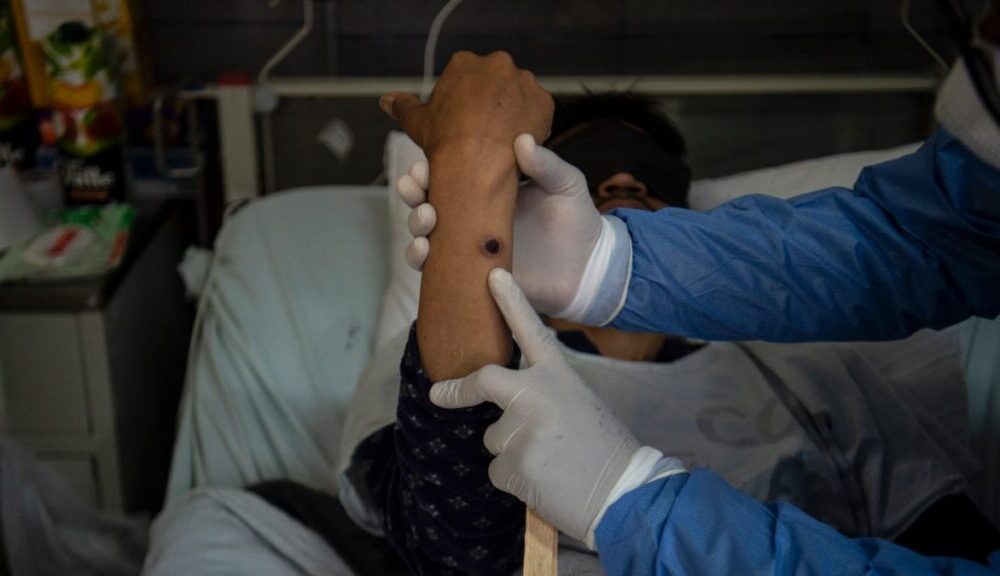 México confirma 49 casos de mpox en 11 estados no hay casos de nueva